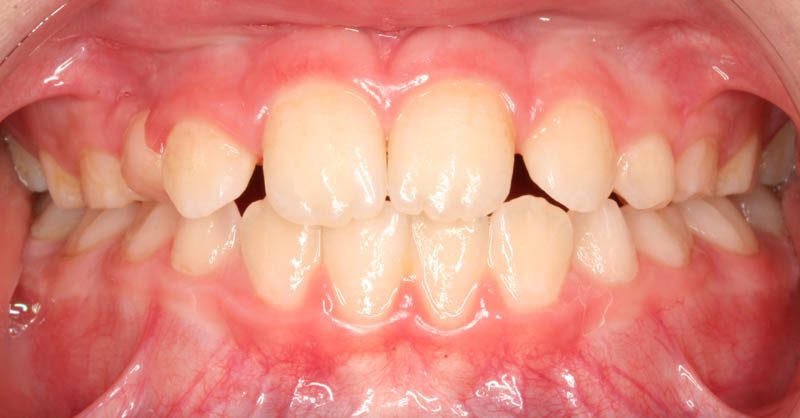 crossbite openbite after