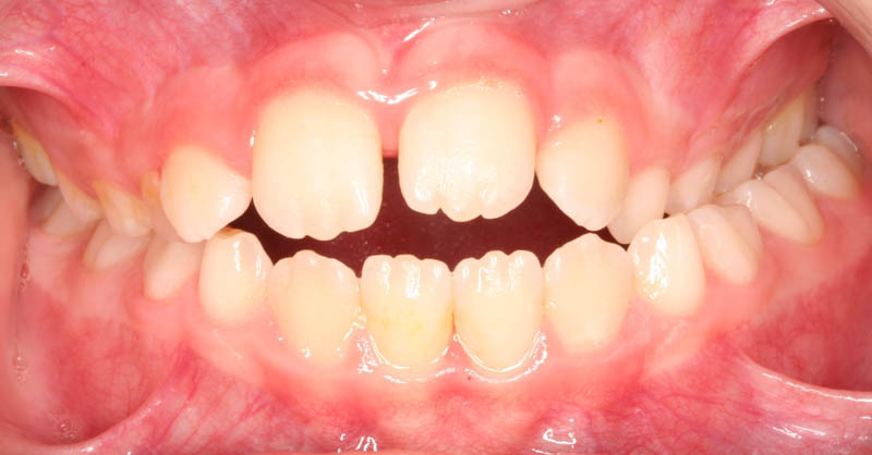 crossbite openbite before treatment