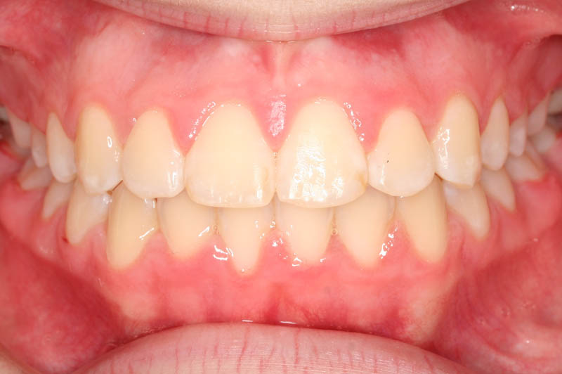 crowding with ectopic canines after treatment