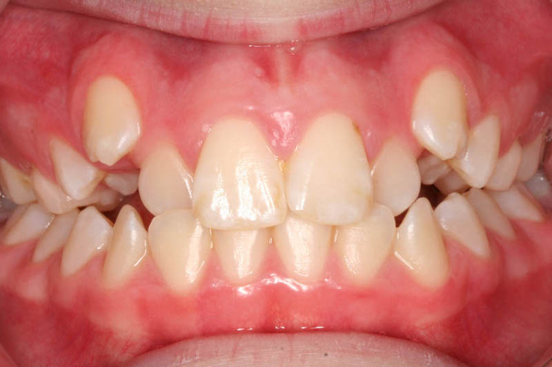 crowding with ectopic canines treatment