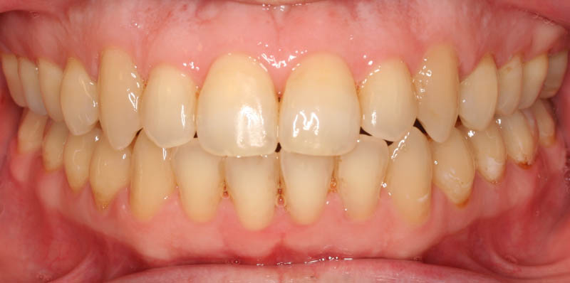 open bite adult after treatment