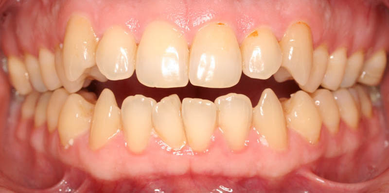 open bite adult before treatment