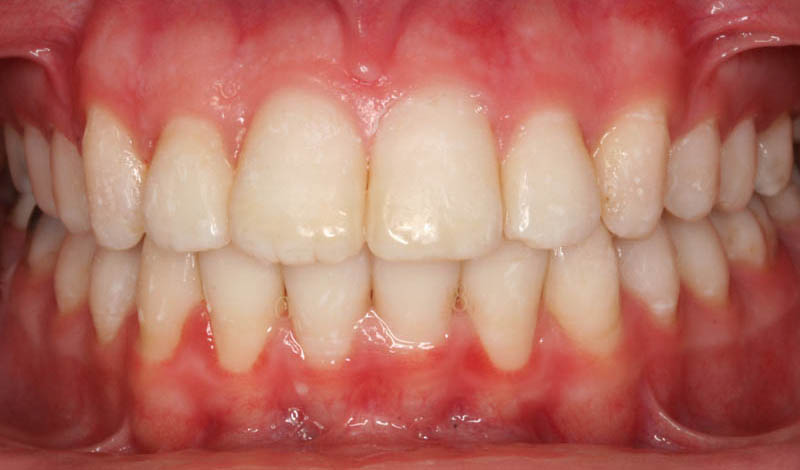 open bite and overjet after treatment