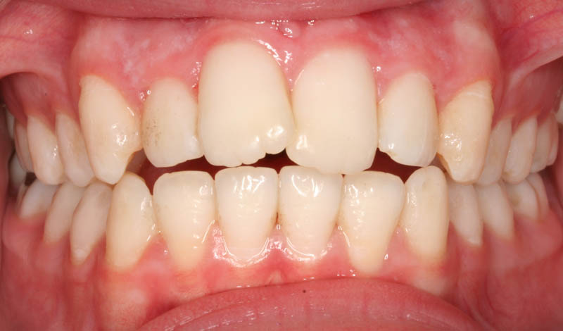 open bite and overjet before treatment