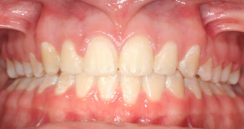 overbite after treatment