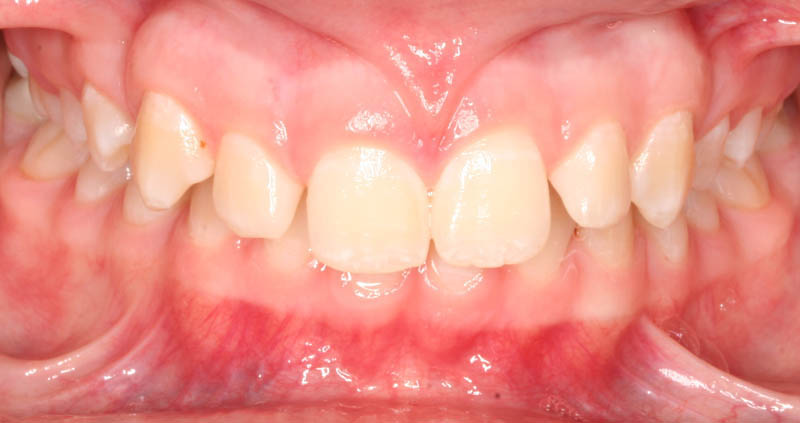 overbite before treatment