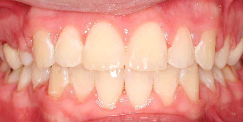overjet after treatment