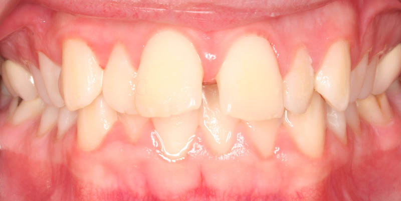 overjet before treatment
