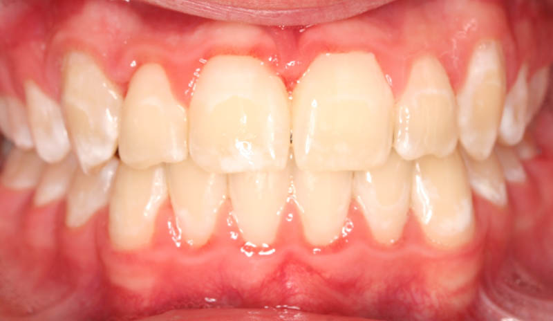severe crowding and diastema after treatment