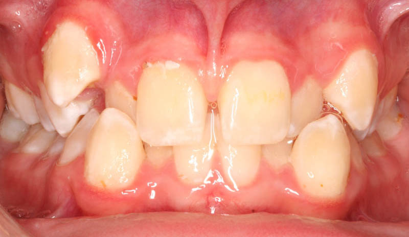 severe crowding and diastema before treatment