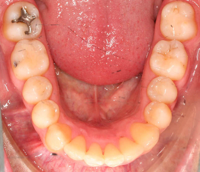 severe crowding lower teeth after treatment