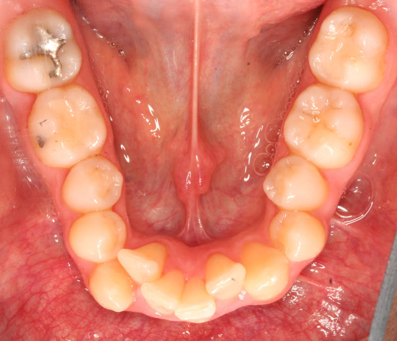 severe crowding lower teeth before treatment