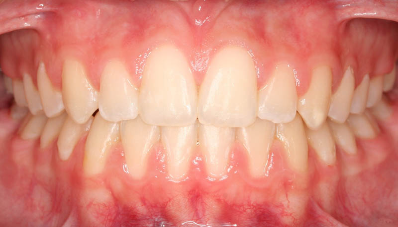 teeth spacing after treatment