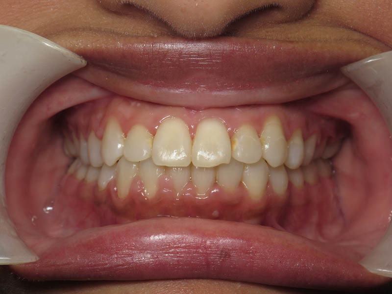 teeth underbite after treatment