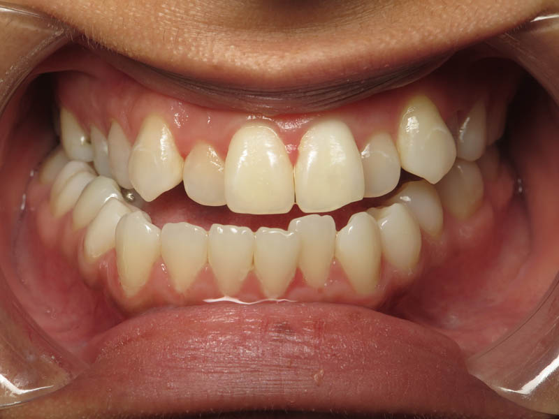 teeth underbite before treatment